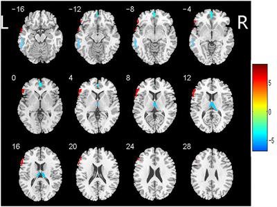 Contribution of Inflammation and Hypoperfusion to White Matter Hyperintensities-Related Cognitive Impairment